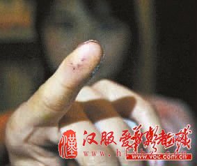 手指被针扎了4个小孔。