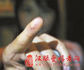 　　手指被针扎了4个小孔。